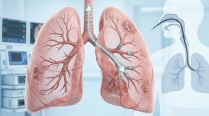 Is Bronchoscopic Lung Volume Reduction the Future for Advanced COPD Patients?